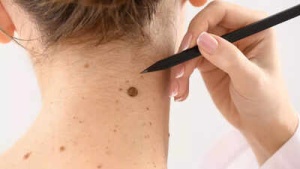 6 Subtle Melanoma Signs You Might Be Missing: Protecting Yourself From Hidden Skin Cancer Risks