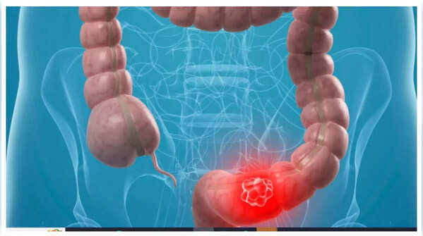 Abdominal discomfort as possible colon cancer sign