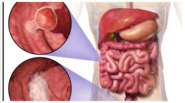 Detecting blood in stool