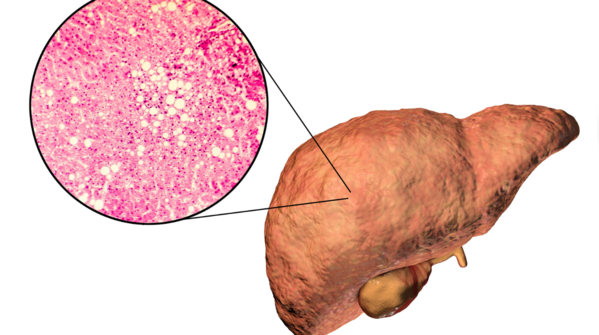 What is fatty liver